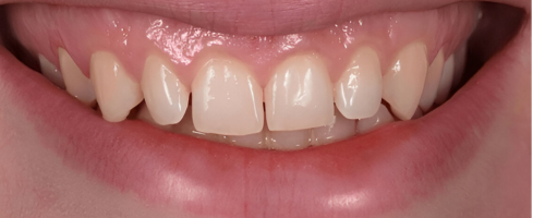 veneers And laminate (1)